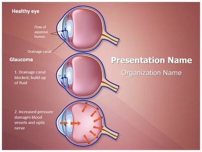 Glaucoma powerpoint templates glaucoma powerpoint (ppt slides for themes free